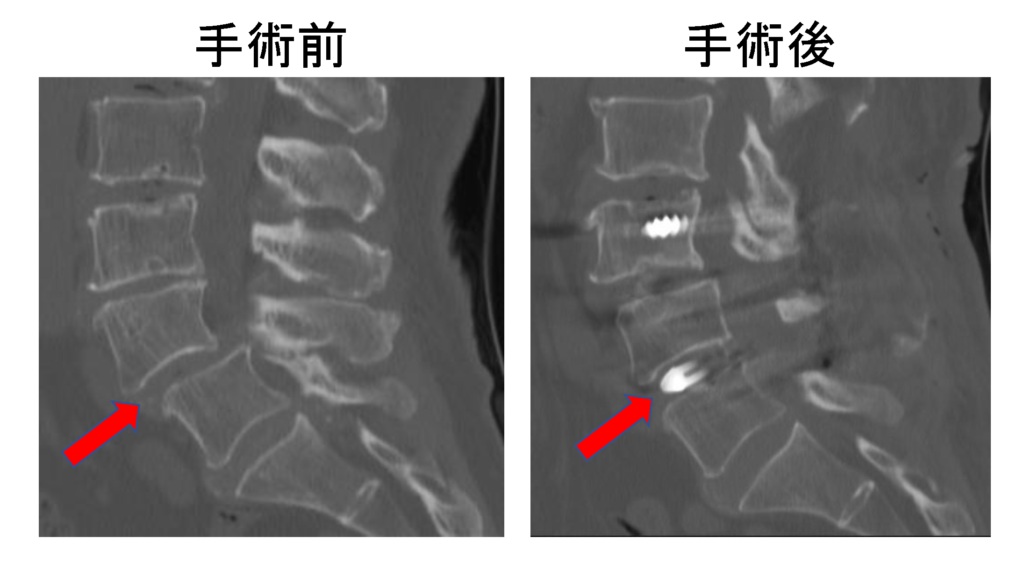 腰椎変性